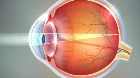 H52.2 Astigmatizma