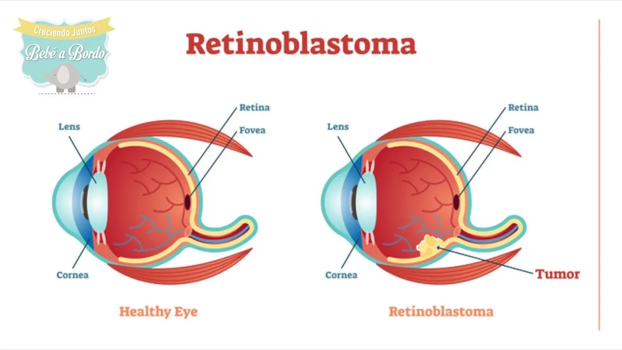 Retina Yirtigi2